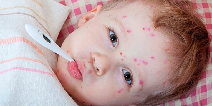 Кір – дуже заразне і серйозне захворювання